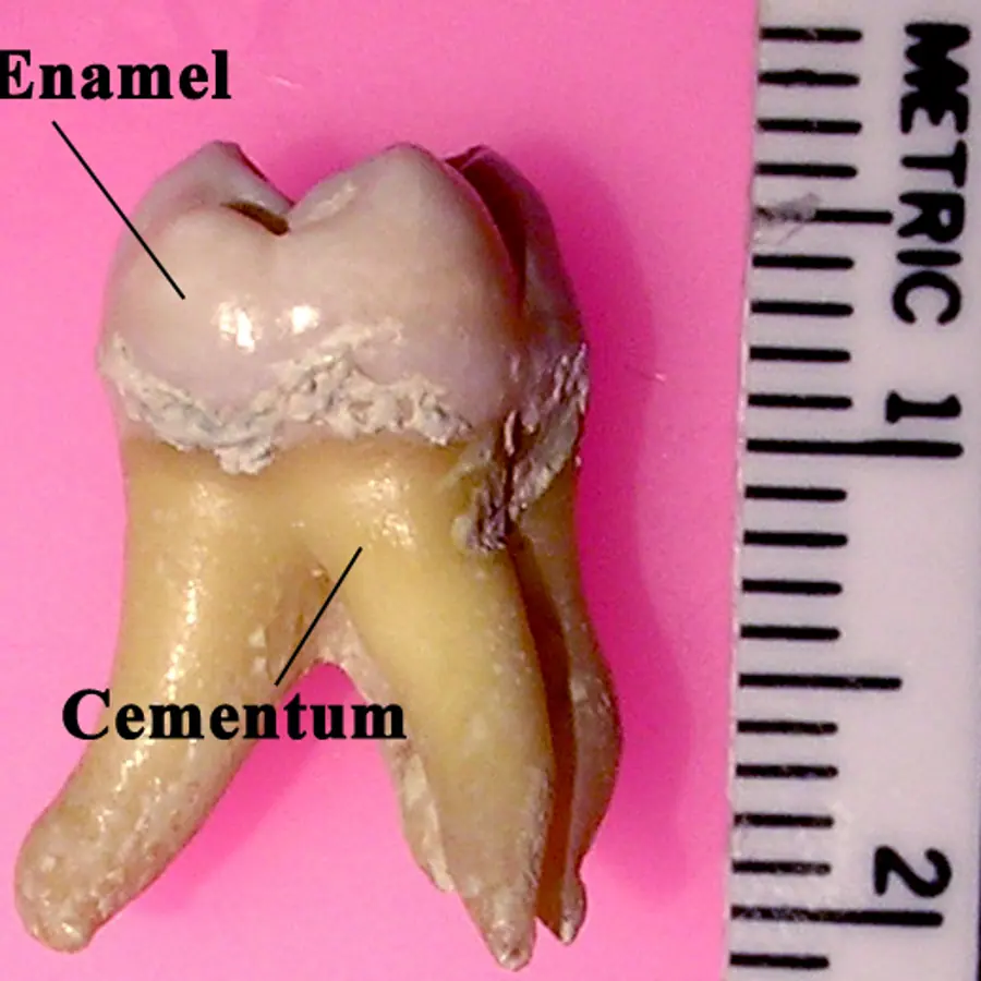 Enamel–dentin transitions — visual reference