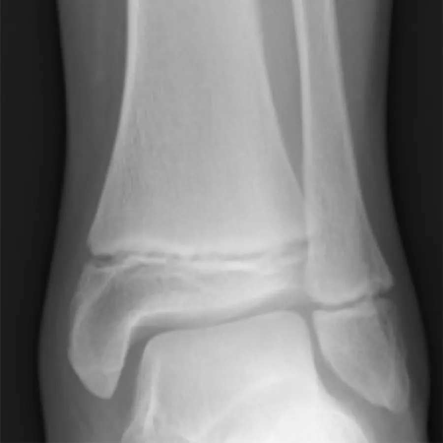 Growth cartilage — visual reference