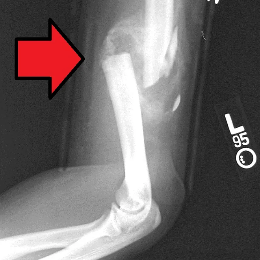 Bone callus — visual reference