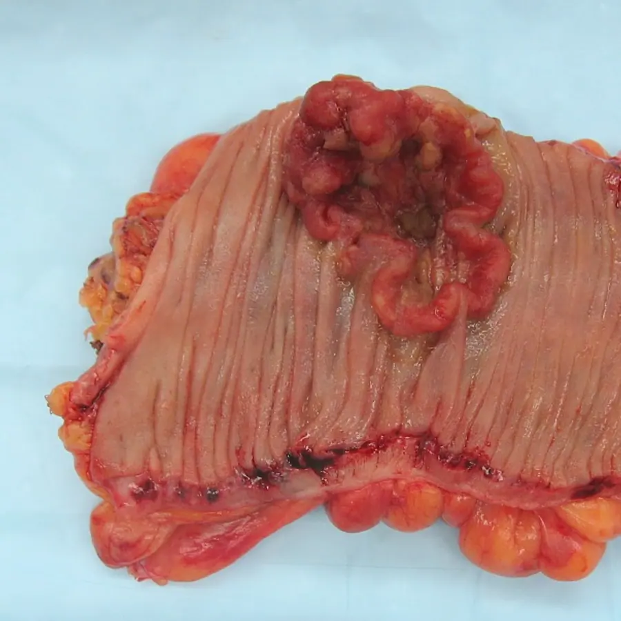 Tumor (avascular core + diffusion shell) — visual reference