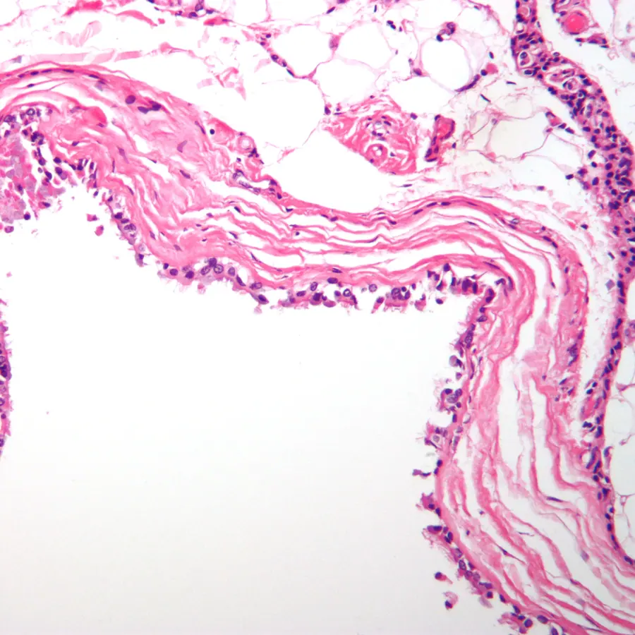 Cysts — visual reference