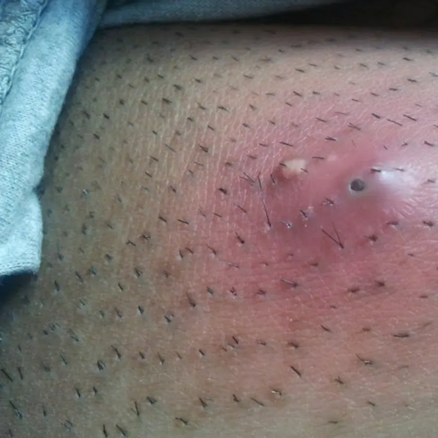 Abscesses — visual reference